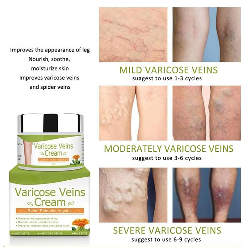 Varicose Veins Healing Cream